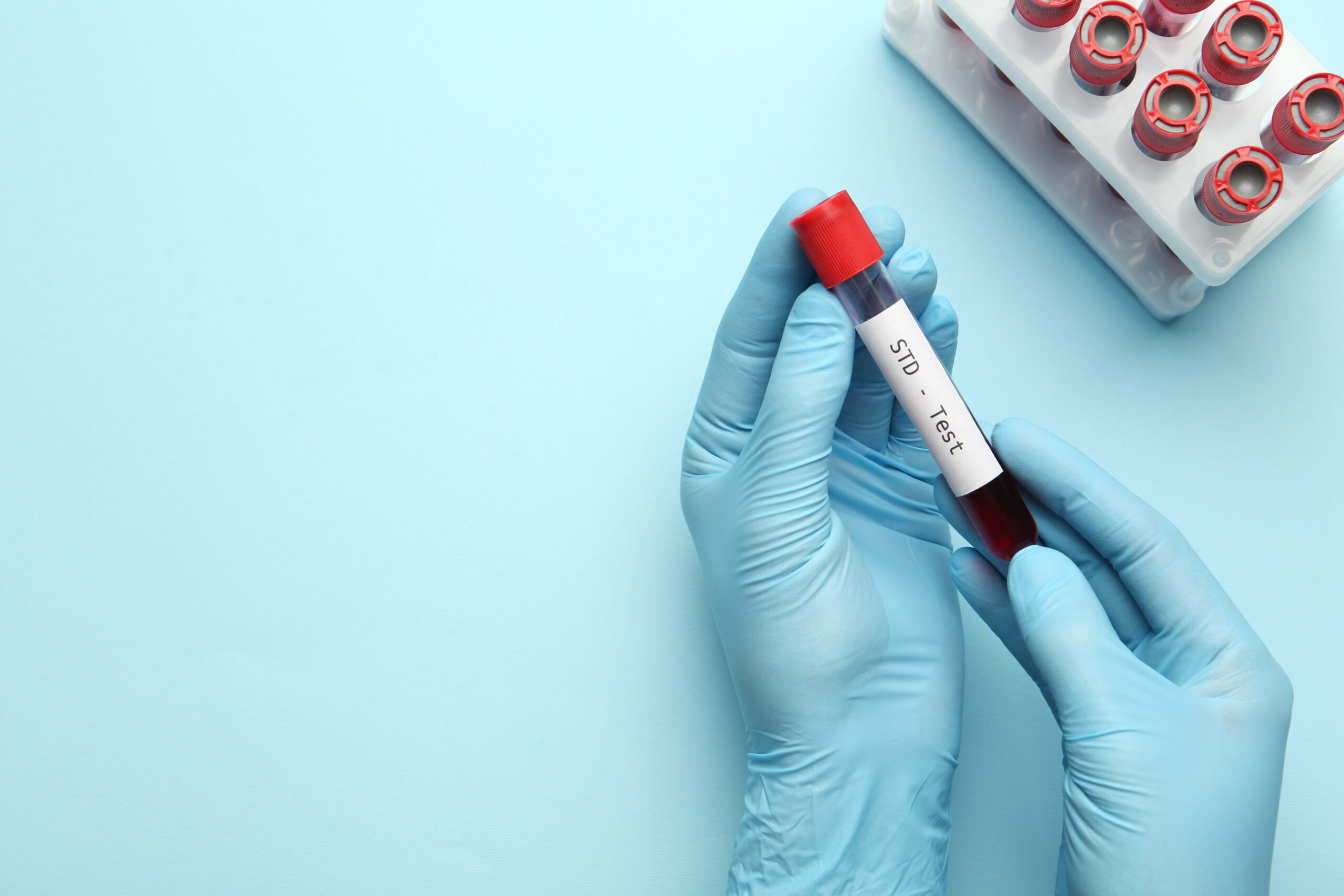 Scientist holding tube with blood sample and label STD Test on light blue background, top view.